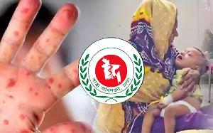 ২৪ ঘণ্টায় হাম উপসর্গে ৫ শিশুর মৃত্যু