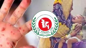 হামের উপসর্গে আরও ৬ শিশুর মৃত্যু