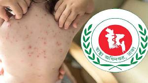 হাম ও উপসর্গে এখন পর্যন্ত ৭৮০ জনের মৃত্যু